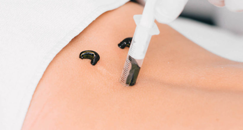 Patient During Leech Therapy, Alternative Hirudotherapy, Blood Purification stawianie pijawek