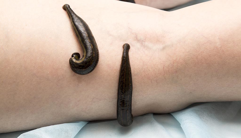 Treatment Of People Of Medical Leeches. Treatment Of People Of Medical Leeches.