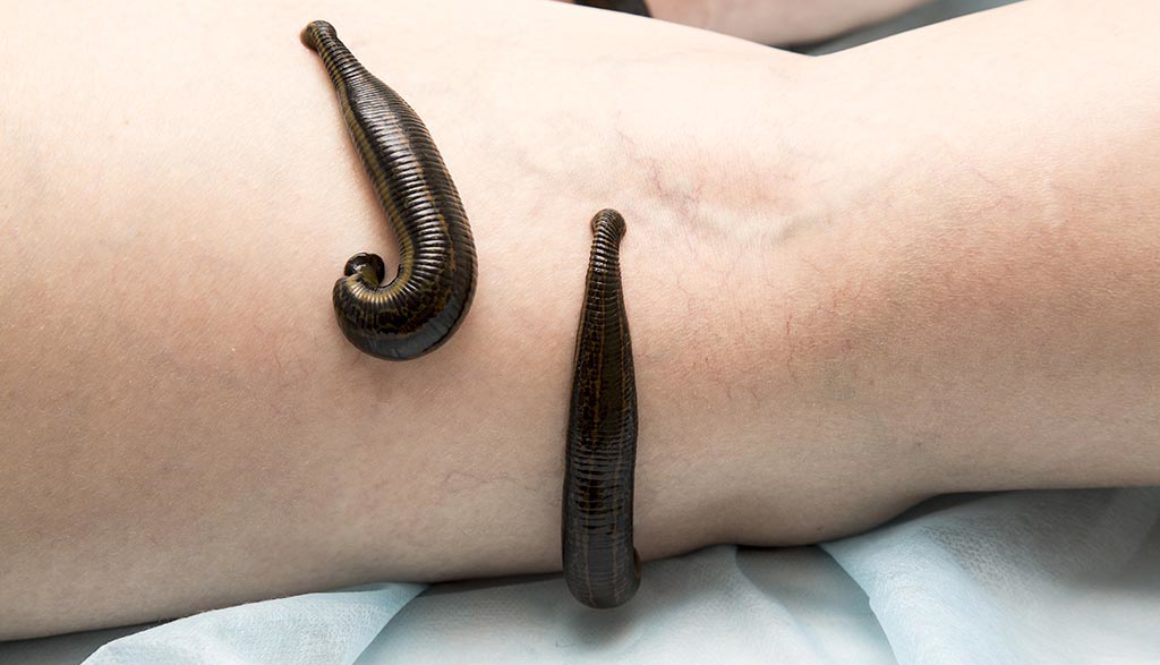 Treatment Of People Of Medical Leeches.