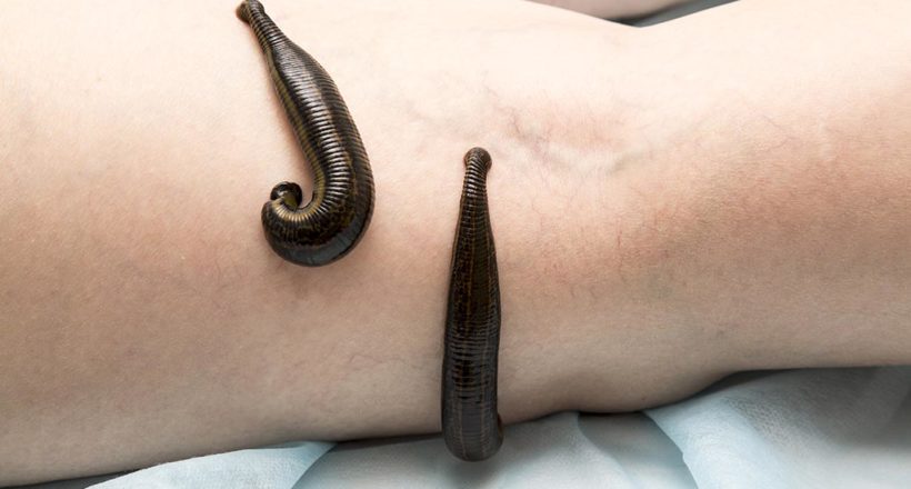 Treatment Of People Of Medical Leeches. Treatment Of People Of Medical Leeches.