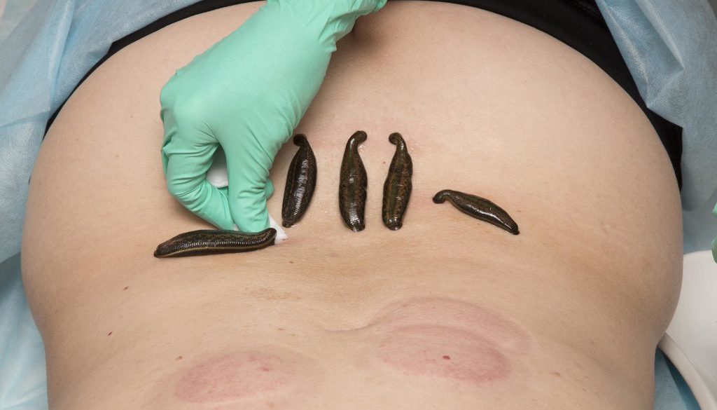 Treatment Of People Of Medical Leeches. Treatment Of People Of Medical Leeches.
