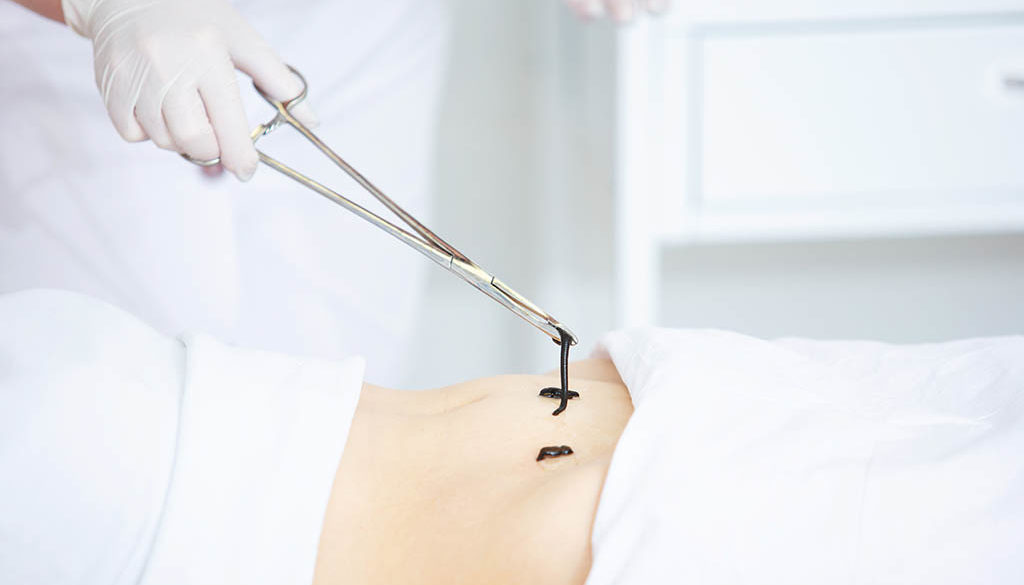 Doctor In The Clinic Puts Medicinal Leeches On A Woman's Stomach, Close Up Doctor In The Clinic Puts Medicinal Leeches On A Woman's Stomach, Close Up
