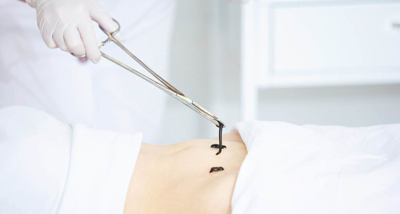 Doctor In The Clinic Puts Medicinal Leeches On A Woman's Stomach, Close Up Doctor In The Clinic Puts Medicinal Leeches On A Woman's Stomach, Close Up