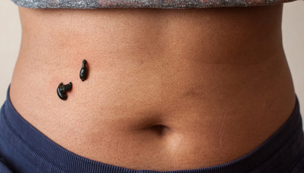 Ayurvedic Medical Leech Liver Treatment Ayurvedic Medical Leech Liver Treatment