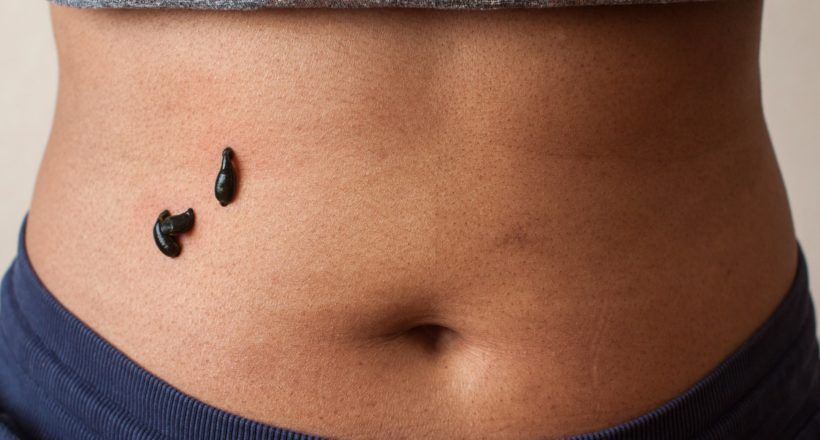 Ayurvedic Medical Leech Liver Treatment Ayurvedic Medical Leech Liver Treatment