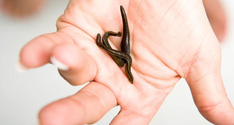 Leech Therapy With Medical Leeches On Human Body. Naturopathy, H pijawki