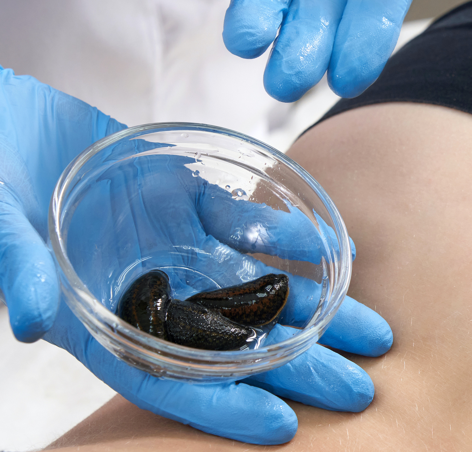 Leech Therapy For Haemorrhoids How Can Leeches Help With Haemorrhoids Leech Therapy For Haemorrhoids How Can Leeches Help With Haemorrhoids